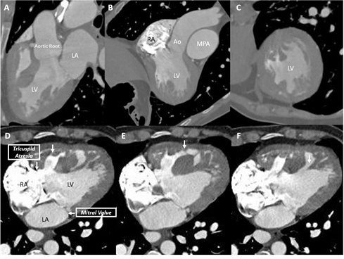 Figure 1: A) Dominant LV & rudimentary RV; B) RA connected to LV; C) Cross-sectional image of ventricle displays single ventricle; D) Normal mitral valve and atretic tricuspid valve; E) Simultaneous contrast filling of RV & LV; Small RV contrast filling curved to LV.