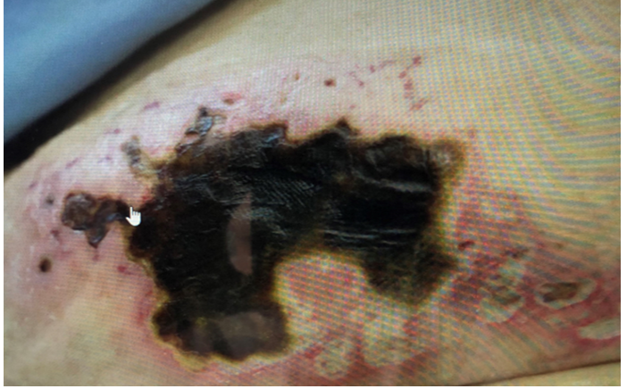 Figure 6: Certain blood thinners.