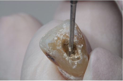 Figure 1: Photograph of tooth filled with Biodentine.