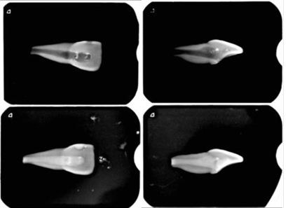 Figure 2: Radiography of instrumented and filled teeth.