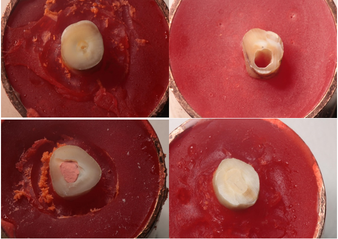 Figure 3: Photograph of teeth prepared for fracture resistance testing (in order from top to bottom and right to left: tooth without tartar, tooth treated without filling, tooth filled with Gutta-percha and tooth filled with Biodentine).