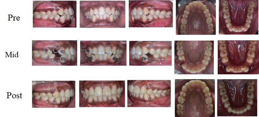 Figure 1: Intraoral photograph showing a case of miniscrew implant assisted absolute anchorage.