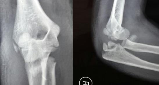 Figure 1: Pre reduction Anteroposterior (A) and Lateral (B) radiograph showing type I Monteggia fracture equivalent (? Fracture of olecronon with Salter-Harris type I physeal injury to proximal radius).