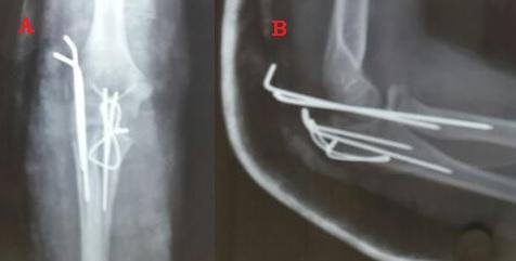 Figure 3: Post Operative Xray. Essentially, Monteggia the lesion consists of dislocation of the head of the radius with a fracture of ulnaat various levels. Bado, in series of 40 patients, described 4 patterns and classified them according to direction of dislocation of the radial head [3]. He suggested that these injury types should be referred to as “Monteggia lesions” [3,4] (Table 1).