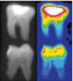 Figure 1: ** Thermographic image of an inflamed pulp.