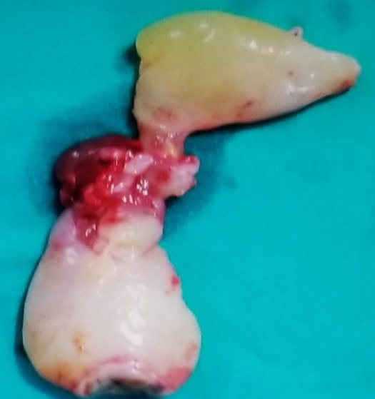 Figure 5: Spheno-choanal polyp.
