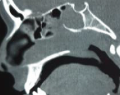Figure 6: Resected part.