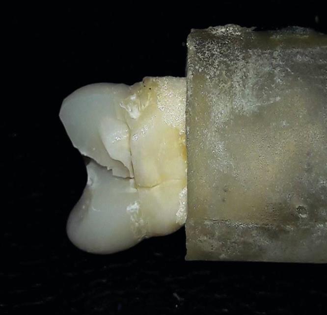 Figure 2: Digital image demonstrating catastrophic fracture (lava ultimate).