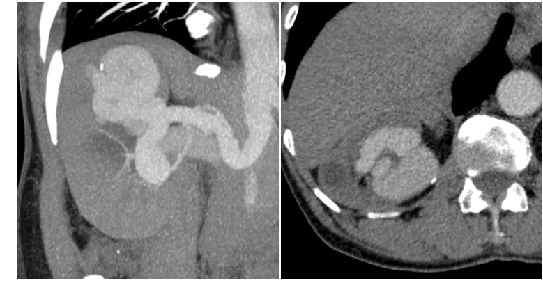 Figure 1: Enlargement of the right main renal artery with an Aneurysmal dilation of the renal vein.