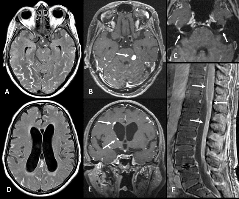 Figure 1: (A) Axial gadolinium-enhanced FLAIR sequence and (B) Axial gadolinium-enhanced T1-SPACE sequence showing diffuse leptomeningeal enhancement in interpeduncular cistern, temporal and occipital lobes, superior aspect of both cerebellar hemispheres. Nodular leptomeningeal enhancement in left ambiens cistern (arrow). (C) Axial gadolinium-enhanced T1-SPACE sequence demonstrates enhancement of complex of seventh and eighth cranial nerves within the internal auditory canals. (D) Axial FLAIR – moderate hydrocephalus with transependymal edema. (E) Coronal gadolinium-enhanced T1-SPACE sequence showing subependymal nodular enhancement (arrow). (F) Sagittal gadolinium-enhanced fat-suppressed T1 sequence of lumbar spine – linear pial and nodular leptomeningeal enhancement in pial surface of conus medullaris and cauda equina roots (arrow).