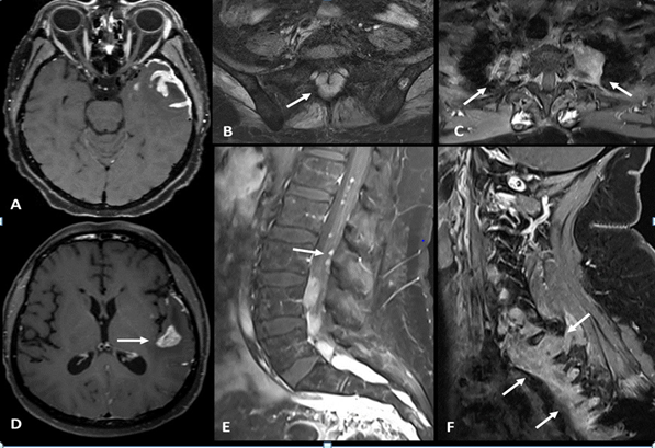 Figure 2: (A, D) Axial gadolinium enhanced T1-SPACE sequence showing leptomeningeal and brain parenchymal enhancement in left temporal lobe. (B) Axial gadolinium-enhanced fat-suppressed T1 sequence of sacrum showing extradural mass lesion within sacral foramina (arrow). (E) Sagittal gadolinium-enhanced fat-suppressed T1 sequence demonstrates nodular enhancement of cauda equina roots (arrow). Axial (C) and Sagittal (F) gadolinium-enhanced fat-suppressed T1 sequence of cervical spine showing paravertebral mass lesion in superior thoracic spine and inferior cervical spine with foraminal and extradural space involvement.