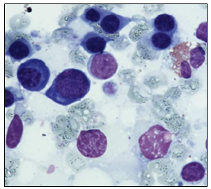 Figure 1: Bone marrow myelogram revealing severe hypoplasia of the granoblastic series.