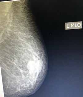 Figure 1: Craniocaudal mammogram of the left breast showing the mass.