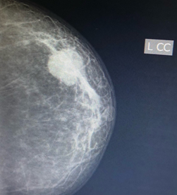 Figure 2: Mediolateral oblique mammogram of the left breast.
