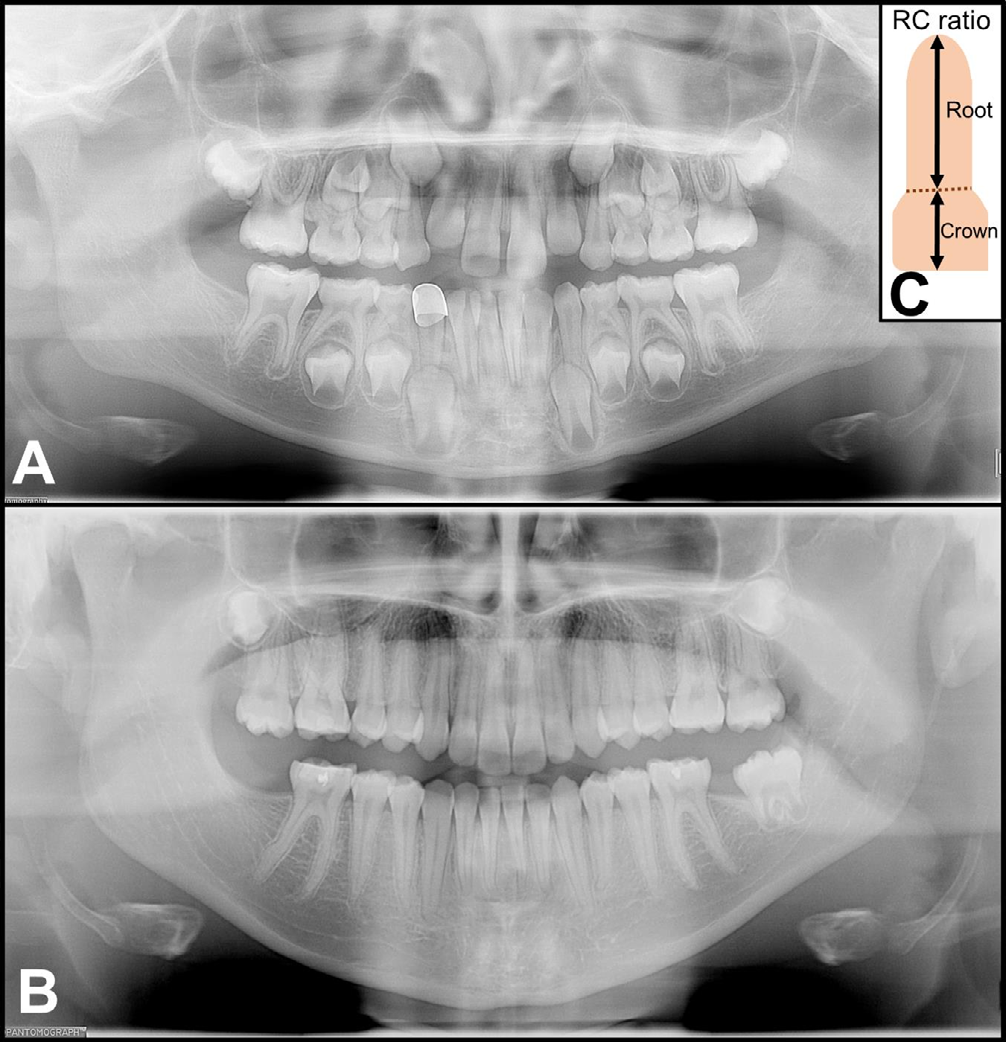 Figure 1: Panoramic radiographs from case 1 taken during mixed dentition (8 years) and permanent dentition (16 years) stages showing non-syndromic, generalized radiculomegaly affecting both primary (A) and permanent dentition (B) along with the schematic to calculate root-crown ratio (C). Note congenital absence of #s 18, 31, and 32 with gemination of #17.