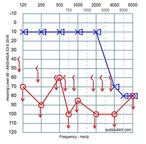 Figure 1: Pure Tone Audiometry. Profound hearing loss in the right ear (opposite site of the blunt) and high pitch hearing loss in the left ear (site of the head trauma impact).