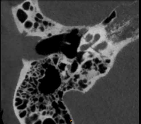 Figure 2: Axial computed tomography displaying a perimodiolar fracture line in the right cochlea as a result of a contrecoup.