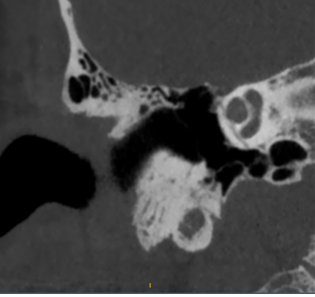 Figure 3: Coronal computed tomography. Transverse fracture line in the right cochlea.