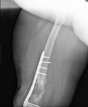 Figure 4: Differences in sizes (about 10cm) from the left leg (normal) and right leg (affected by knee osteomyelitis).
