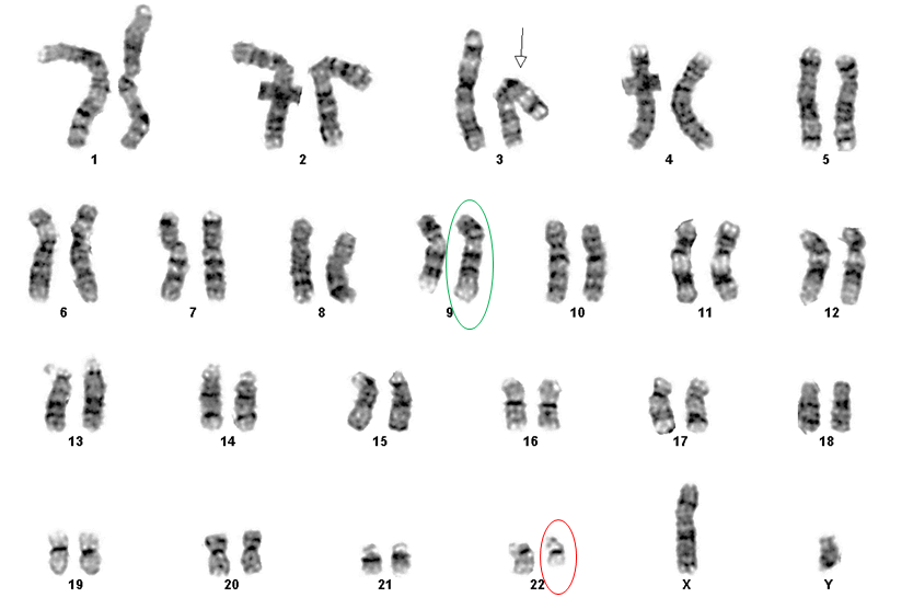 Figure 1: Conventional Cytogenetic Study, Case 1. Karyogram showing 9;22 translocation and inversion 3. Green circle: der(9) chromosome. Red circle: der(22) chromosome. Arrow: inv(3) chromosome.