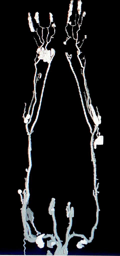 Figure 3: Severe bilateral symmetrical athermanous calcified diffuse plaque disease extending from the level of the mid arm to the palmar branches of the radial and ulnar arteries in MIP image.