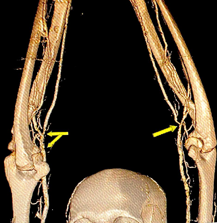 Figure 4: 3D volume image yellow arrow showing stenosis in bilateral brachial arteries.