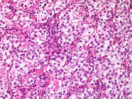 Figure 2: Seminoma delineating tumour cells incorporated with clear cytoplasm, polygonal nuclei, prominent nucleoli and fibrous tissue septa with lymphocytic infiltration traversing the neoplasm.