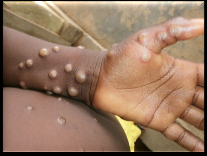 Figure 2: Lesions of monkeypox on human skin [4].