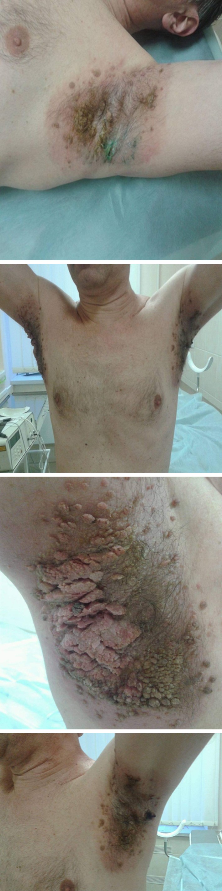 Figure 1: Rashes on the skin of the axillar region