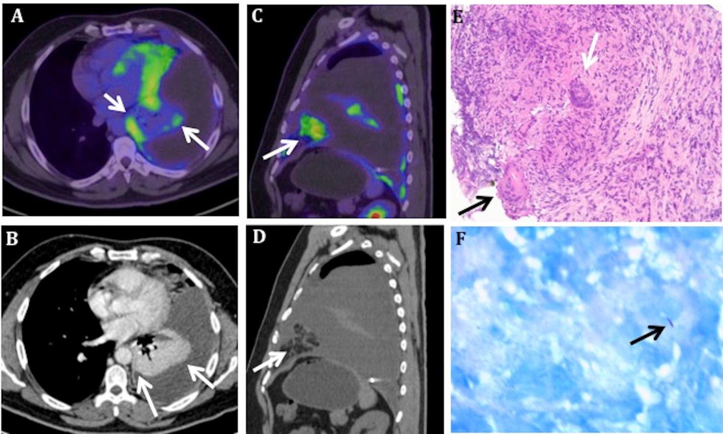 Figure 1: MIP image (A) showing abnormal FDG avid regions limited to the left hemi thorax. Coronal (B) and axial (C) fused PET/CT showing diffusely increased FDG uptake in the left parietal pleura involving the mediastina (arrow in B) and posterior- inferior costal pleura (arrow in C). Coronal (D) and axial (E) CT show gross left pleural effusion (maximum anterior posterior depth ~17.0 cm). Axial CT (E) shows diffuse smooth left pleural thickening in the FDG avid areas. The FDG uptake (SUV max 10.5) is disproportionately high compared to the pleural thickening (~2 mm), which was missed on diagnostic CT thorax.