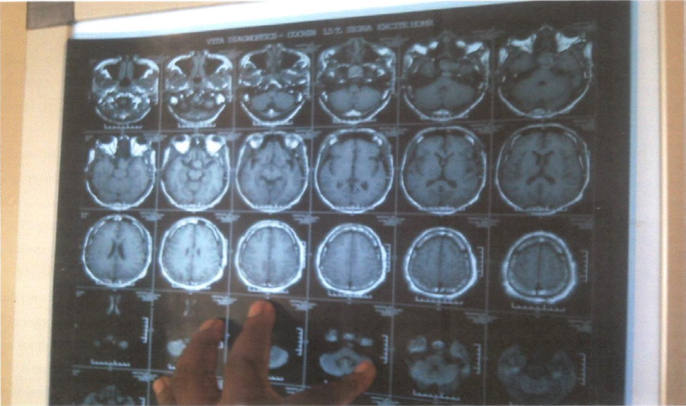 Figure 4: MRI Brain with contrast showing sellar suprasellar lesion extending into the sphenoid sinus. There was an encasement of the cavernous carotid by the tumor. The tumor is better appreciated on the original MRI film, and the Consultant Radiologist report shows the tumor.