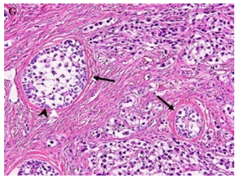 Figure 1: Dysgerminoma exhibiting nests and cords of dis- cohesive cells with eosinophilic cytoplasm, hyperchromatic nuclei and coarse chromatin surrounded by fibrous tissue infiltrated by lymphocytes.