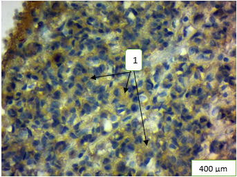 Figure 3: Morphological rearrangements of the pineal gland’s structural components under the condition of 60- days exposure to heavy metal salts and correction with α-tocopherol acetate: 1 - moderately positive expression level of Hsp90α in the cytoplasm of pinealocytes. Immunohistochemical study of Hsp90α expression.