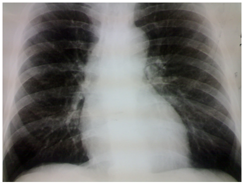 Figure 1: Chest x-ray.