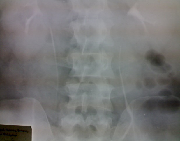Figure 3: Intravenous urogram.