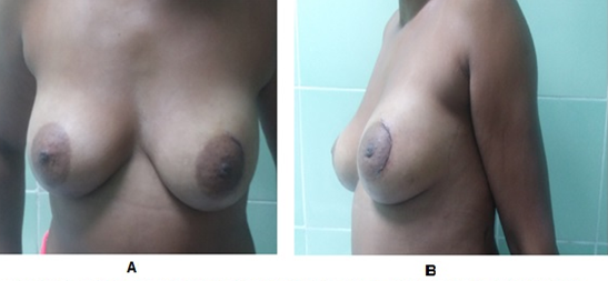Figure 2: One month postoperative period of a patient who underwent excision of a 6-cm benign phyllodes tumor from the left breast and oncoplasty with autologues flaps: A: Front View; B: Side view.