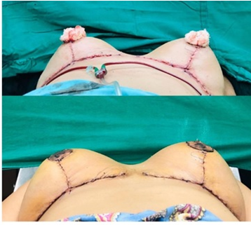 Figure 4: Immediate postoperative period and five days after the thorek technique.