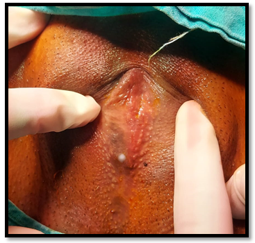Figure 1: Complete fusion of the labia minora with obliteration of the vaginal introitus and urethral meatus with a pinhole opening.