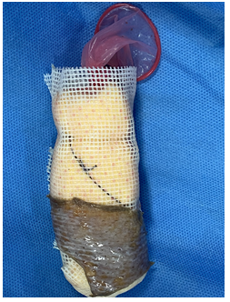 Figure 3: Spacer with condom with graft.