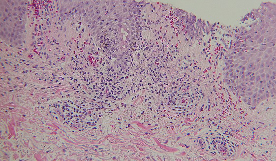 Figure 2: Pathological findings Irregularly elongated epidermis, capillary dilatation and perivascular lymphocyte infiltration in upper dermis.