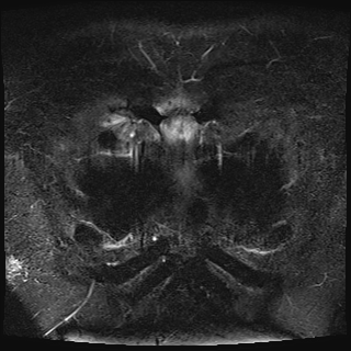 Figure 3: MRI scan, T2 emphasized image Bone marrow edema in the sternum body and manubrium (circle) The chest pain was getting worse; then, secukinumab, an anti-IL-17A monoclonal antibody, was administered. The dose started with 300 mg, followed by 150 mg per week for 4 weeks. After that, 150 mg every 4 weeks was administered.