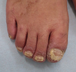 Figure 4: Severe nail deformity