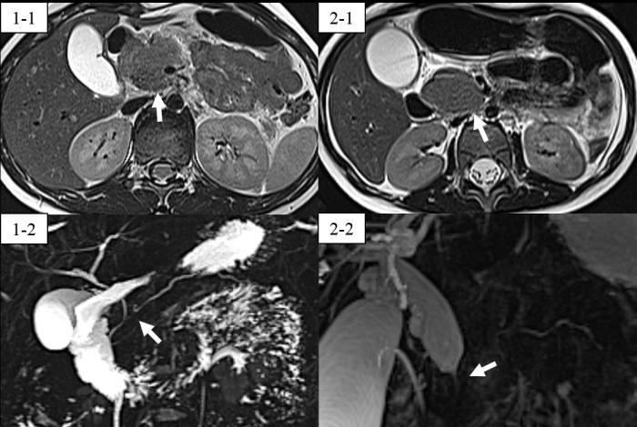Figure 1: MRI results for case 1 and 2. 1-1 and 2-1 show a low T2 intensity mass-like effect at the pancreatic head (arrow). 1-2 shows partially obstructed pancreatic duct and distal common bile duct at the pancreatic head (arrows). 2-2 shows narrowing of the distal common bile duct at the level of the pancreatic head due to the mass- like effect (arrow).