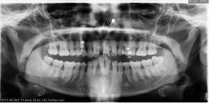 Figure 2: Pretreatment OPG and Lateral Cephalogram.