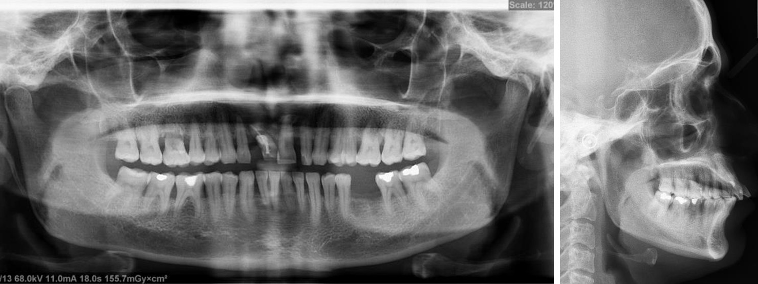 Figure 9: Bonding with 0.018 Roth PEA and application of light continuous forces. Treatment results: Post-treatment facial photographs (Figure 10) show a marked improvement in facial profile, smile aesthetics and confidence of the patient. A Class I molar and canine relationship with an optimum overjet and overbite (2mm and 2mm respectively) was achieved along with a functional occlusion. The mean probing depth was reduced and a marked improvement in periodontal health was noticed. Posttreatment OPG (Figure 11) showed achievement of a favorable crown/root ratio. The horizontal bony defected transformed into vertical defects in upper anterior, upper posterior and lower posterior region which were more conductive to regenerative osseous procedures. No significant root resorption or reduction in alveolar bone spaces were closed by applying light forces using continuous elastomeric chains. Space was maintained in relation to 16 and 36 by a passive closed coil spring. After completion of space closure, an implant was placed in relation to 36. Prosthesis was placed after confirming osseointegration of the implant (four months). Finishing and detailing was carried out and the case was debonded. A removable prosthesis was delivered for replacement of 16. Fixed spiral retainers were placed in both upper and lower arches for long term retention. Total treatment duration was 14 months.