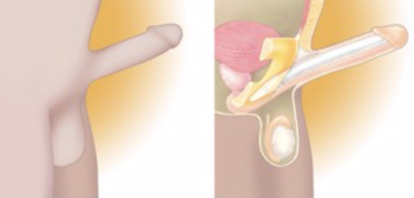 Figure 1: One-component inflatable PP Bostonscientific.