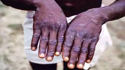 Figure 1: Cutaneous symptoms of Monkeypox.