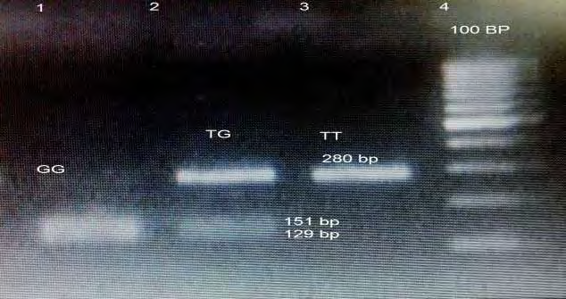 Figure 1: TLR1 1805 T/G PCR products of 4 samples. Lane (4) 100 bp ladder sample 1,3 TG genotype, in lane (2) GG genotype.