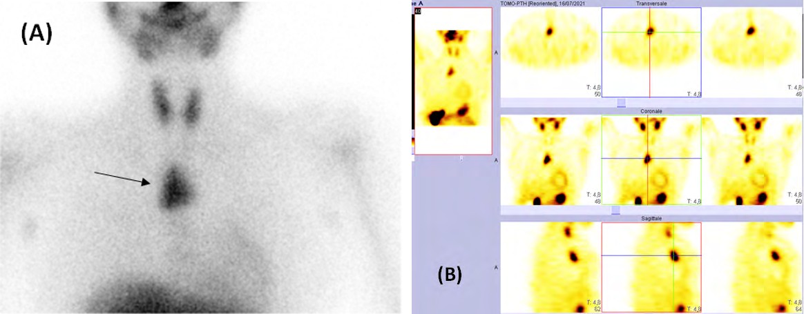 Figure 1: Planar (A) and single-photon emission computed tomography images (B) with axial, sagittal and coronal views showing an increased tracer uptake localized in the anterior superior mediastinum, consistent with an ectopic parathyroid adenoma (arrow).
