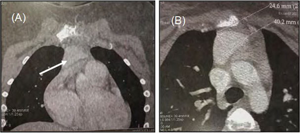 Figure 2: Coronal (A) and axial (B) views of chest computed tomography demonstrating the ectopic parathyroid adenoma (arrow) in the mediastinum.